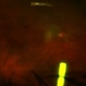 Intravitreal Implant Intravitreal Implant